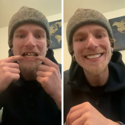 Las carillas Pop On son increíbles.