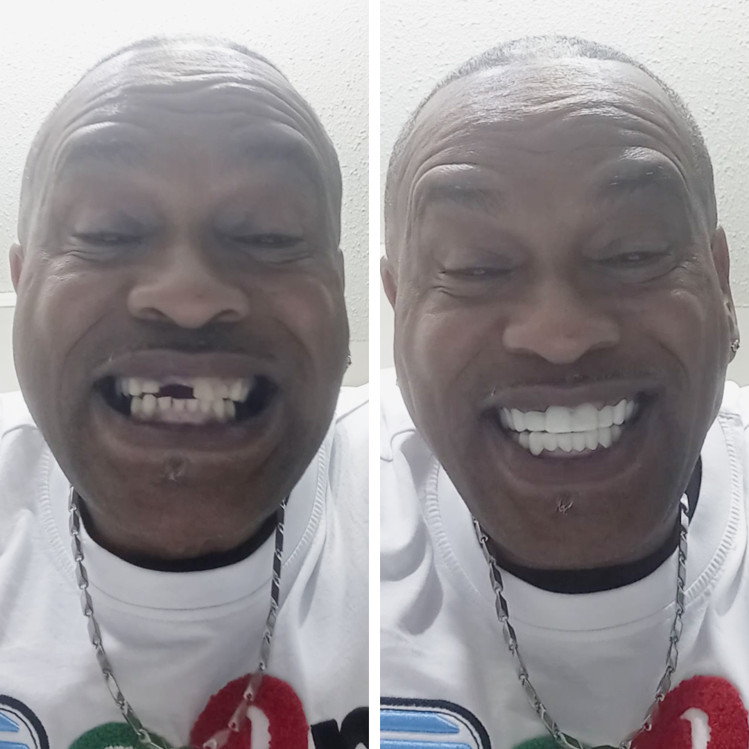 ¡Las carillas Pop On cambiaron mi sonrisa!