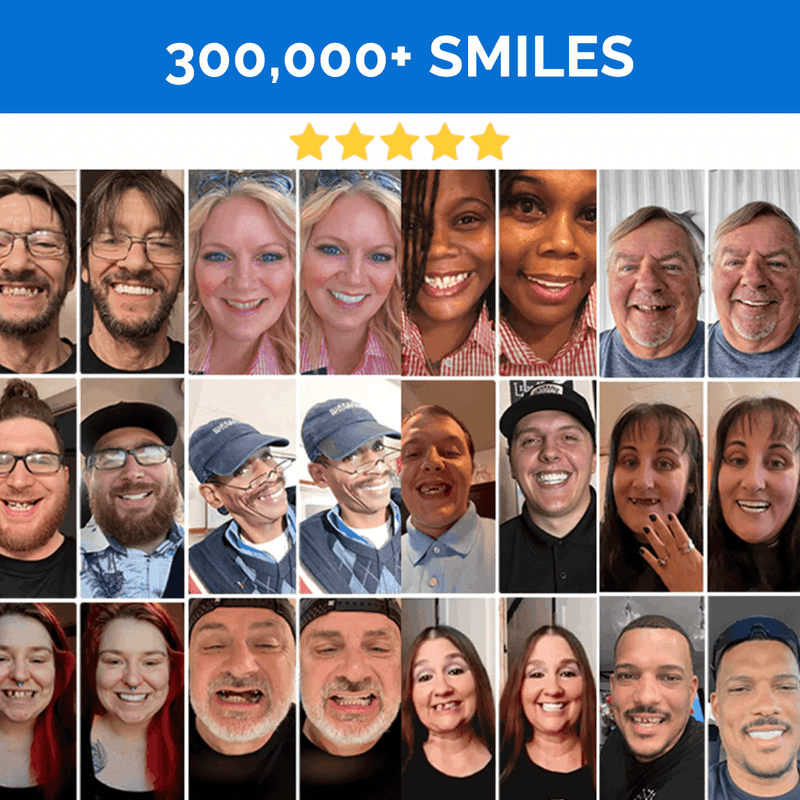 Pop On Veneers with Impression Kit