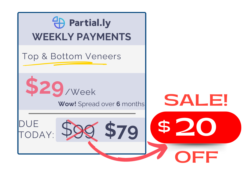 Weekly Payment Plan - Pop On Veneers - $20 Off